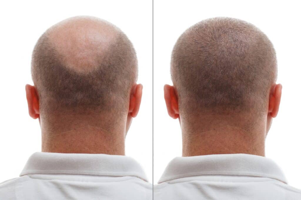 לפני ואחרי השתלת שיער