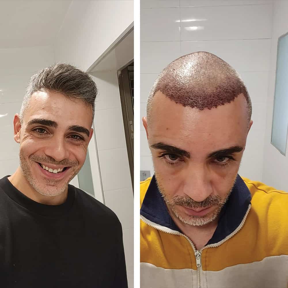 לפני ואחרי שיער